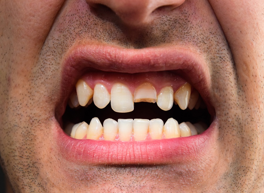 What Should You Do in a Dental Emergency?