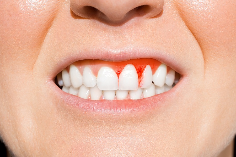 The Dangers of Gum Disease