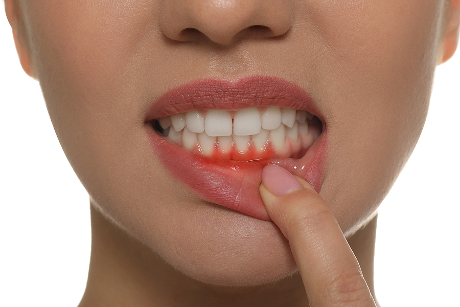 What Causes Gum Disease?