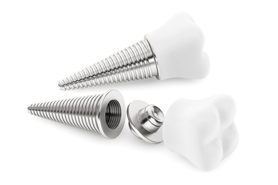 The Ultimate Guide to Dental Implants: Restoring Your Smile with Confidence